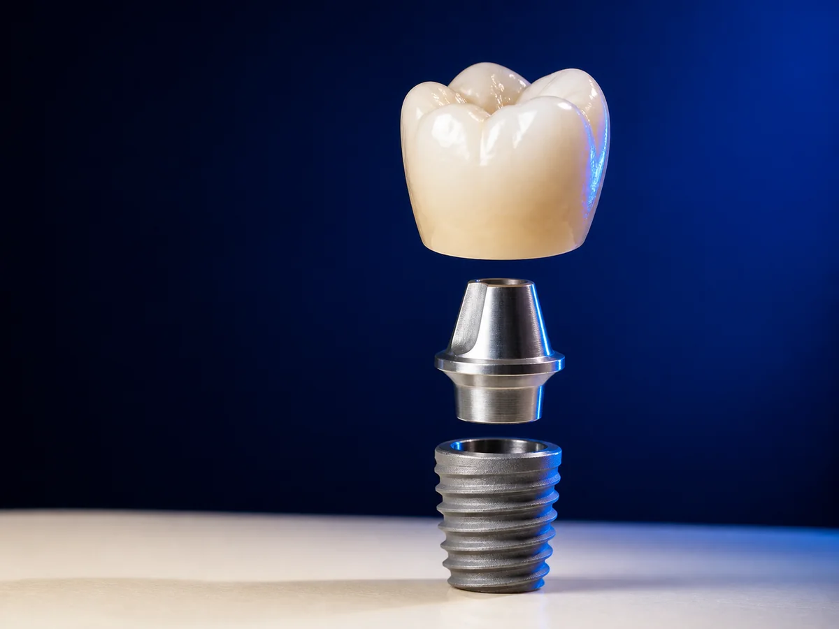 Couronne sur implant et pilier implantaire